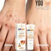 CREMA ELIMINADORA DE VERRUGAS Y LUNARES DERMATOLOGY AICHUM